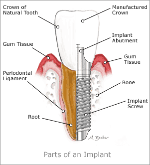 parts of implants